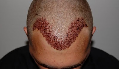 04-Hair-Transplant-Doctor-Patient-2-PostOp-Front.jpg