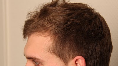 05-Hair-Transplant-Doctor-Patient-2-Seven-Months-Right.jpg