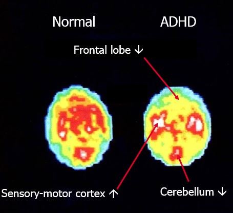 1-frontal-lobe-mri (1).jpg