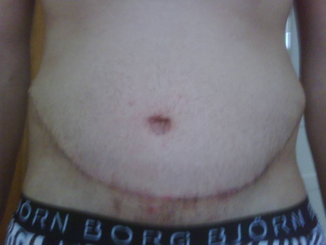 2 weken na de operatie.jpg