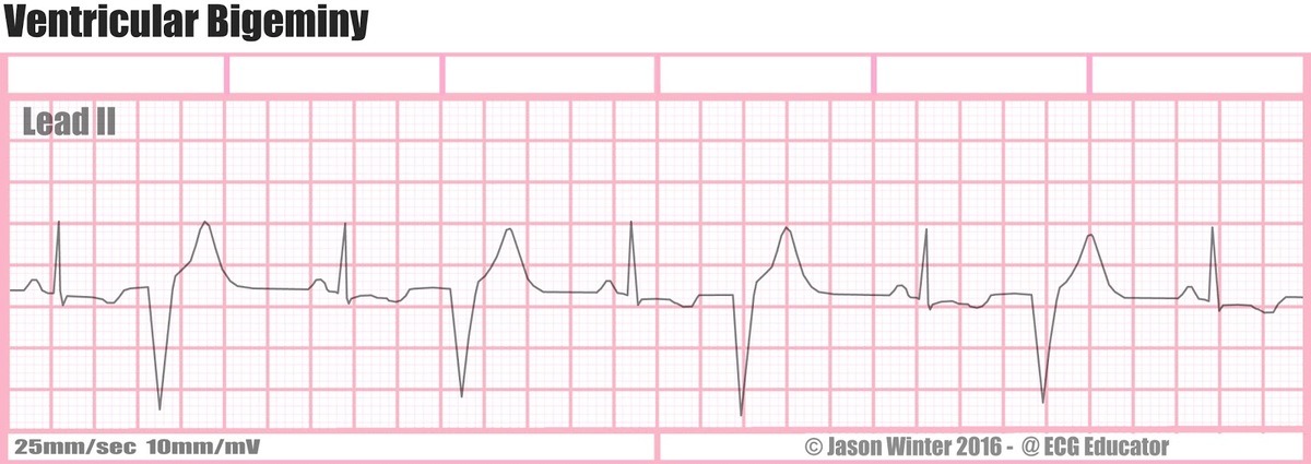 31%2529%2BVENTRICULAR%2BBIGEMINY.jpg