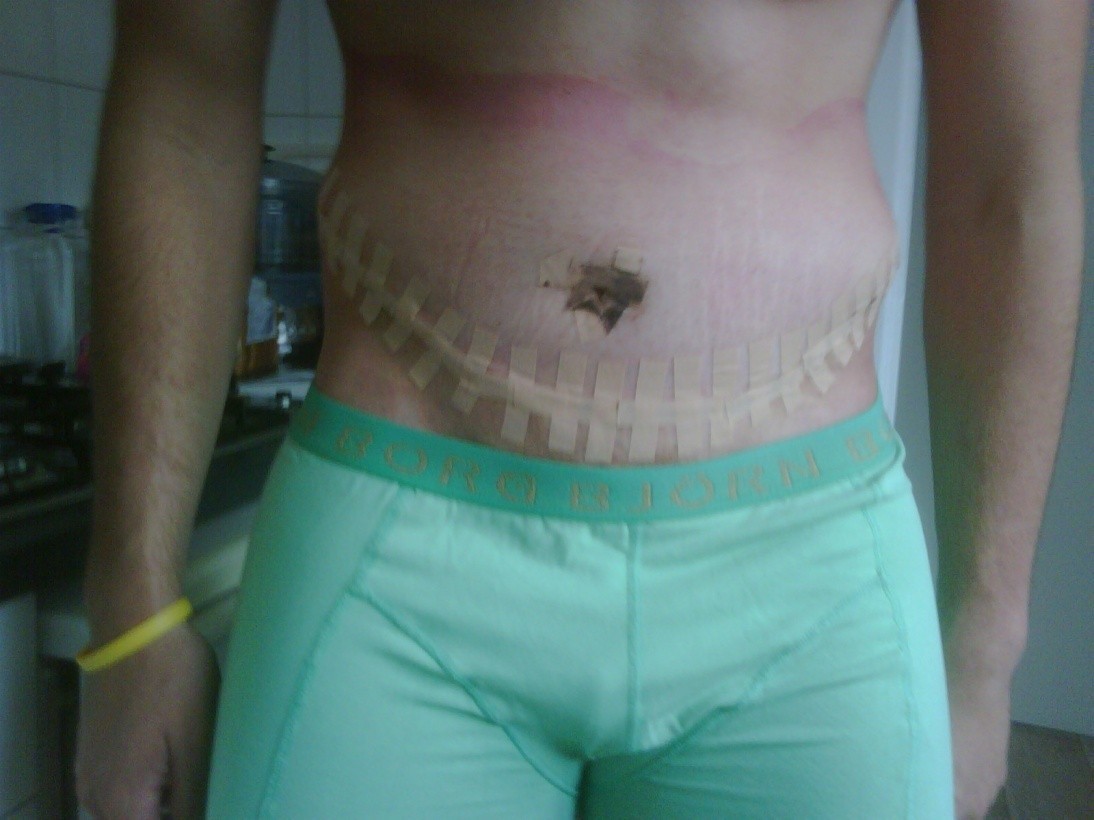 4 dagen na de operatie.jpg