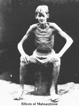 a_malnutrition.gif