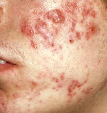acne3.jpg