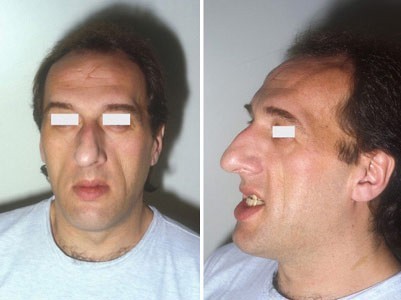 Acromegaly_prognathism.jpg
