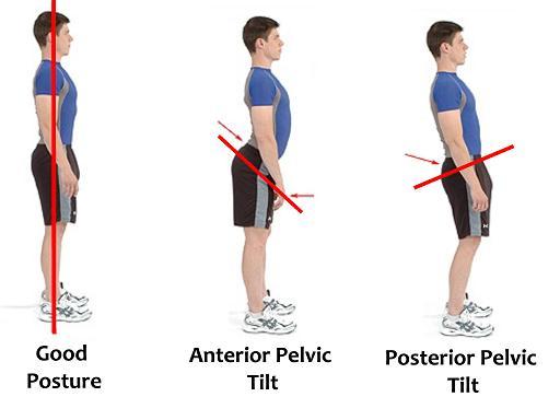 anterior-pelvic-tilt.jpg