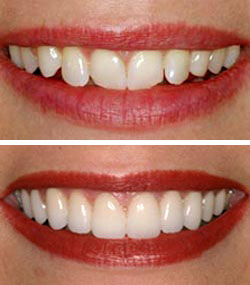 cosmetic-dentistry-lethbridge-veneers-before-after.jpg