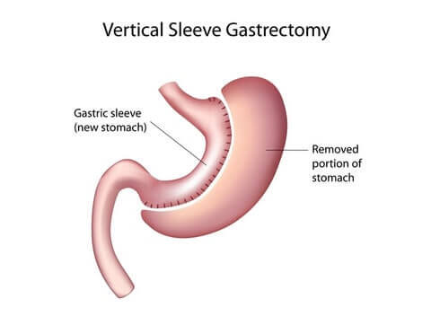 img-med-gastric-sleeve-resized.jpg