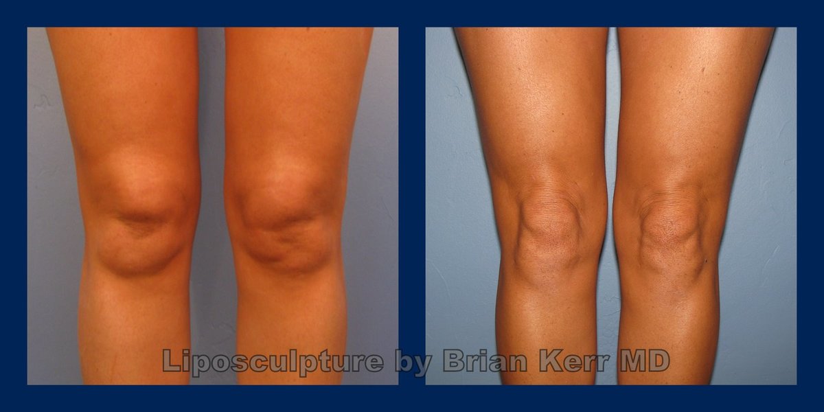 knee%20liposuction,%20smartlipo,vaser,%20before%20after,%20brian%20kerr%20md.p,k%20(2)1.jpg