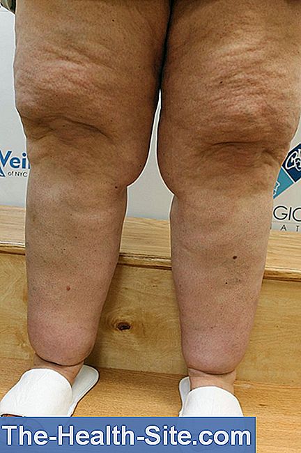 lipoedema.jpg