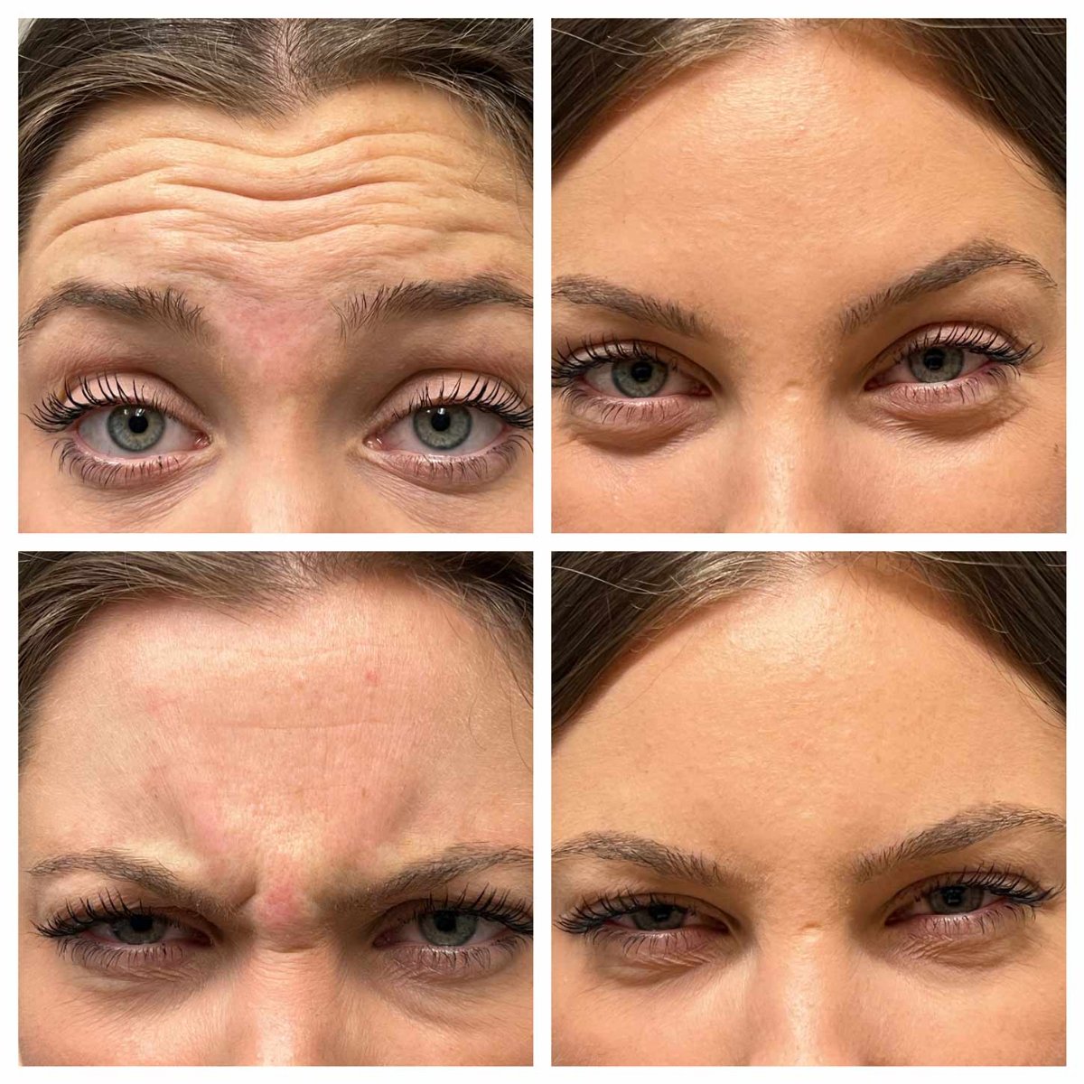 patient-who-received-botox-in-forehead-2.jpg