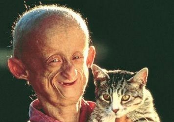 Progeria.jpg