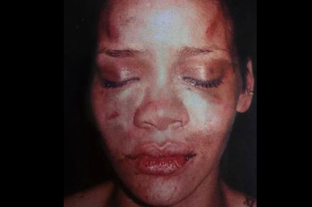 Rihannas-face-after-boyfriend-Chris-Brown-attacked-her-1732203.jpg