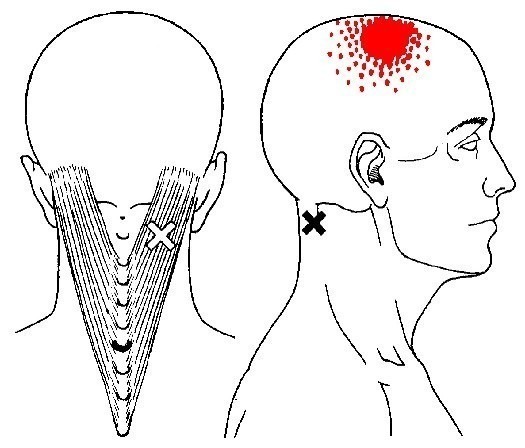 splenius-capitis-trigger-points.jpg