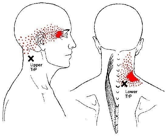 splenius-cervicis-trigger-points.jpg