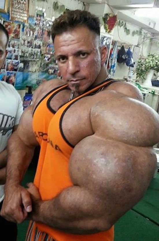 synthol-and-steroid-bodybuilder-18.jpg