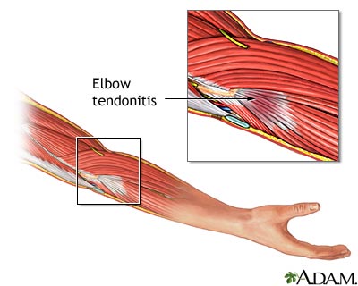 tendonitis1.jpg