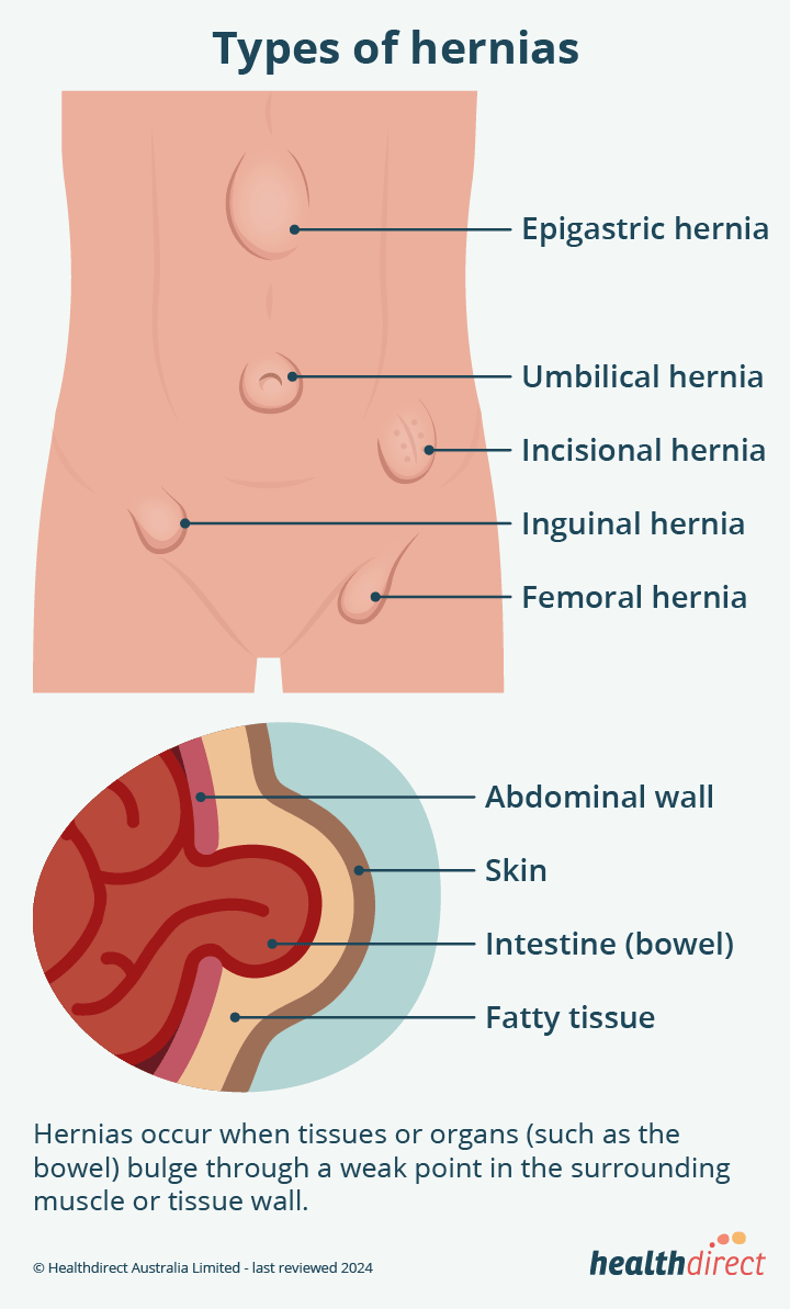 types-of-hernias_device-f12a64.gif