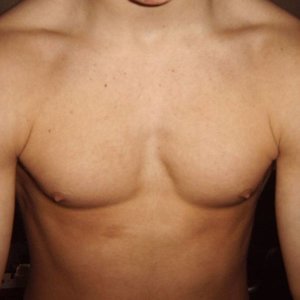 Aangespannen borst oktober 2006