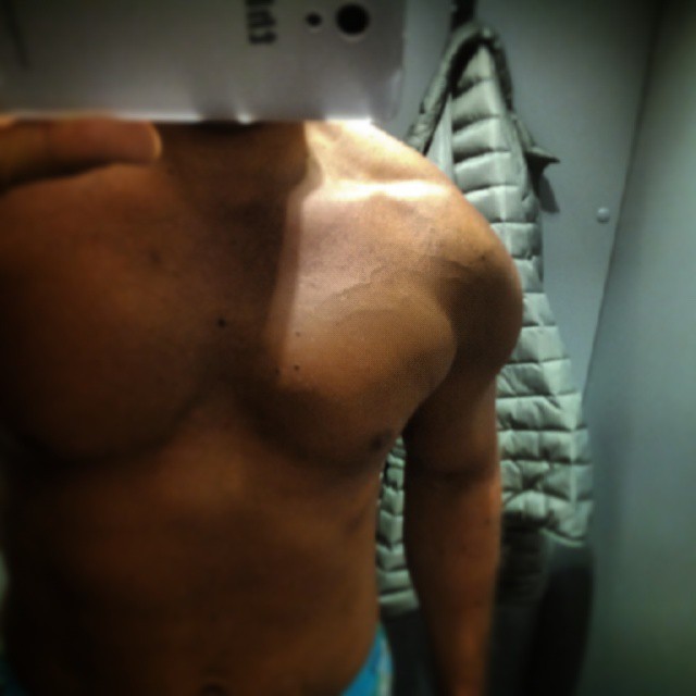 chestveins